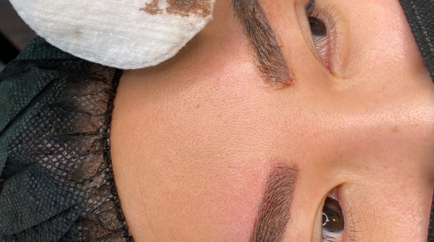 PhiRemoval Eyebrow Tattoo Removal