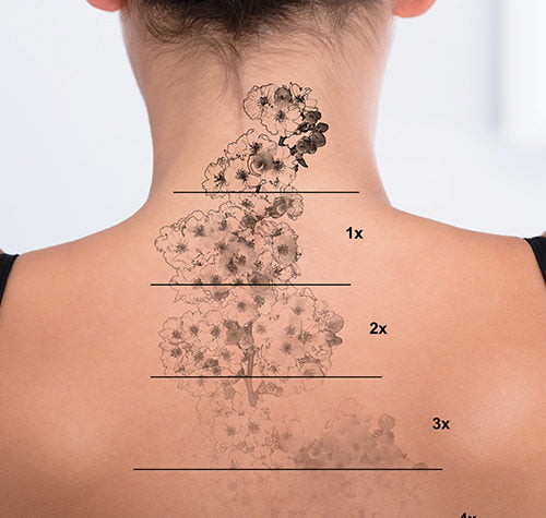 PhiRemoval Tattoo Removal vs Laser Tattoo Removal Kayana Beauty