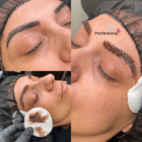 Eyebrow Tattoo Removal Process