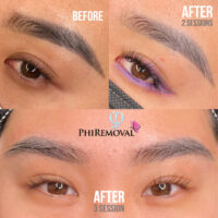 Irene EyeBrow Removal Kayana Beauty Three Sessions