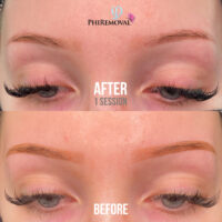 Renae Eyebrow Removal Kayana Beauty One Session