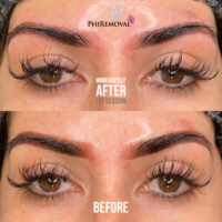 Beverly Removal Before After Kayana Beauty Claremont