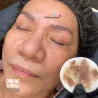 Bhi During PhiRemoval Kayana Beauty Claremont