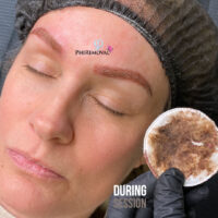 Brandie During PhiRemoval Kayana Beauty Claremont