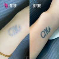 Crystal Body Tattoo Removal Kayana Beauty Claremont