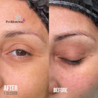 Denise Microblading Removal Before After Kayana Beauty Claremont