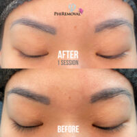 Hong Removal Before After Kayana Beauty Claremont