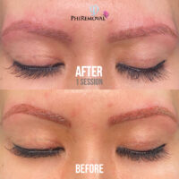 Jennifer Removal Before After Kayana Beauty Claremont-1
