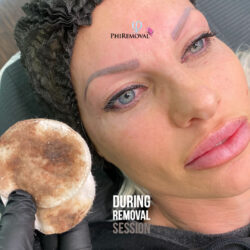 Jill During PhiRemoval Kayana Beauty Claremont Jill During PhiRemoval Kayana Beauty Claremont