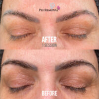 Leila Eyebrow Tattoo Removal Before After Kayana Beauty Claremont