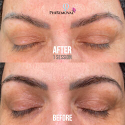 Leila Eyebrow Tattoo Removal Before After Kayana Beauty Claremont Leila Eyebrow Tattoo Removal Before After Kayana Beauty Claremont