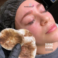 Melissa N During PhiRemoval Kayana Beauty Claremont