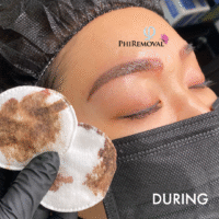 PhiRemoval Microblading Removal During Hiromi
