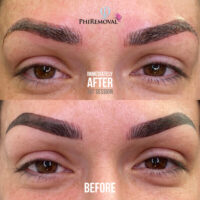 Rosanna Removal Before After Kayana Beauty Claremont