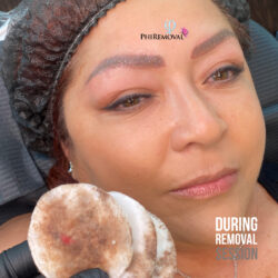 Ruby During PhiRemoval Kayana Beauty Claremont Ruby During PhiRemoval Kayana Beauty Claremont