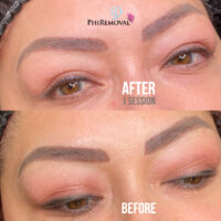 Ruby Removal Before After Kayana Beauty Claremont