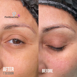 Denise Microblading Removal Before After Kayana Beauty Claremont Denise Microblading Removal Before After Kayana Beauty Claremont