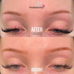 Renae Eyebrow Removal Kayana Beauty One Session Renae Eyebrow Removal Kayana Beauty One Session