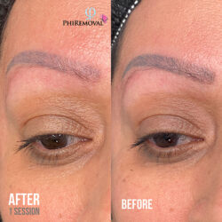 Wendy Eyebrow Removal Kayana Beauty One Session Wendy Eyebrow Removal Kayana Beauty One Session